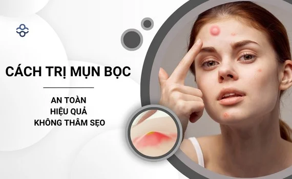 Cách trị mụn bọc nhanh nhất trong 1 đêm.