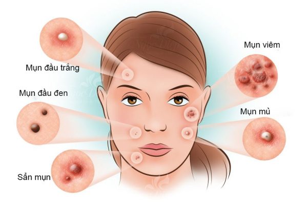 cách trị mụn trứng cá nhanh nhất trong 1 đêm